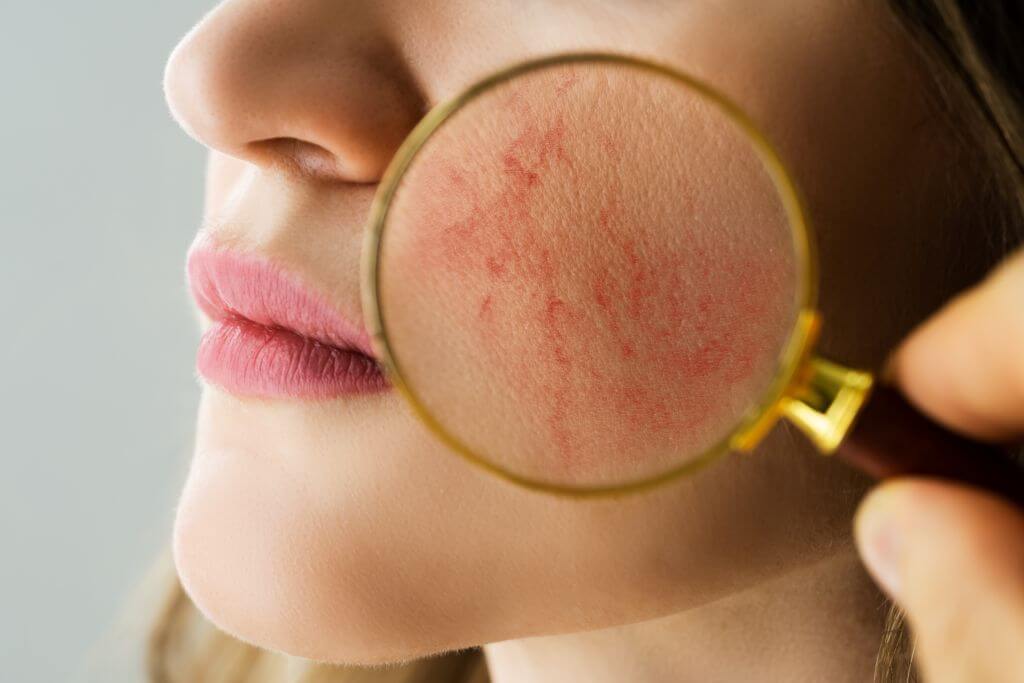 rosacea kezelése lézerrel